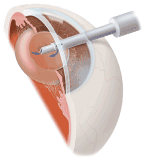 Cataract Anderson | Intraocular Lens Implantation