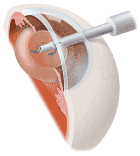 Intraocular Lens Implantation Cataract Anderson | Intraocular Lens Implantation