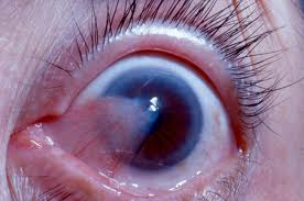 pterygium picture